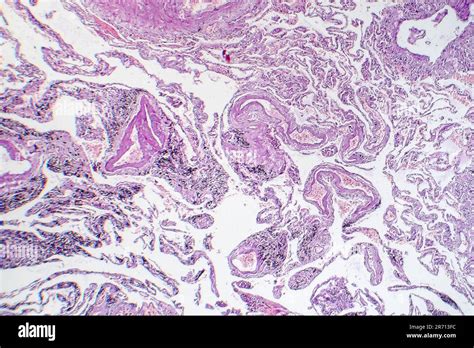 Smoker S Lung Histopathology Light Micrograph Showing Accumulation Of