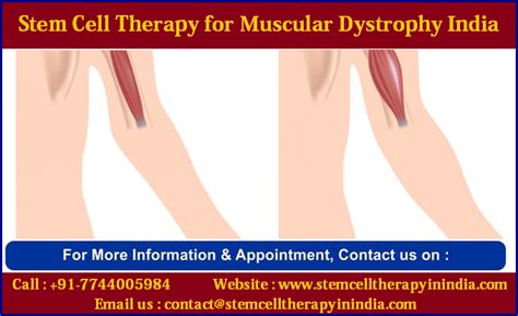 Affordable COST Stem Cell Therapy for Muscular Dystrophy India Cord ...