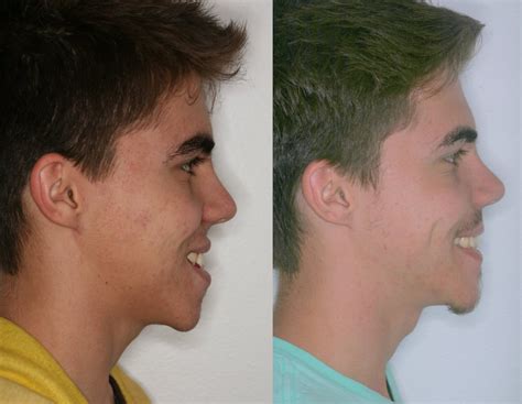 Orthognathic Surgery DrBeckmann