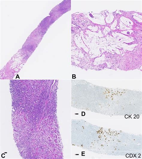 Photomicrographs Of The Lymph Node Biopsy Fragment Of A Lymph Node Download Scientific Diagram