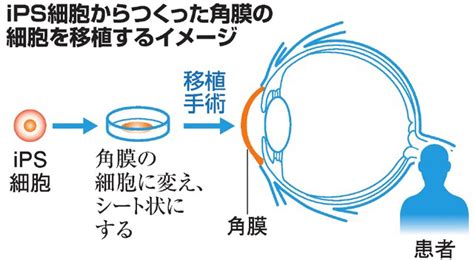 科學研究 【日本ips細胞研究報告 廿七 】阪大篇：世界首例ips角膜移植 客觀日本