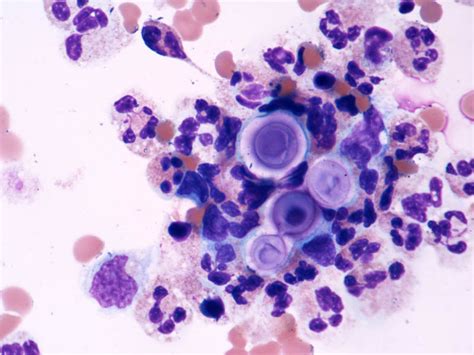 Cryptococcus Neoformans Gram Stain