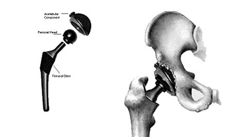 Total Hip Arthroplasty Download Scientific Diagram