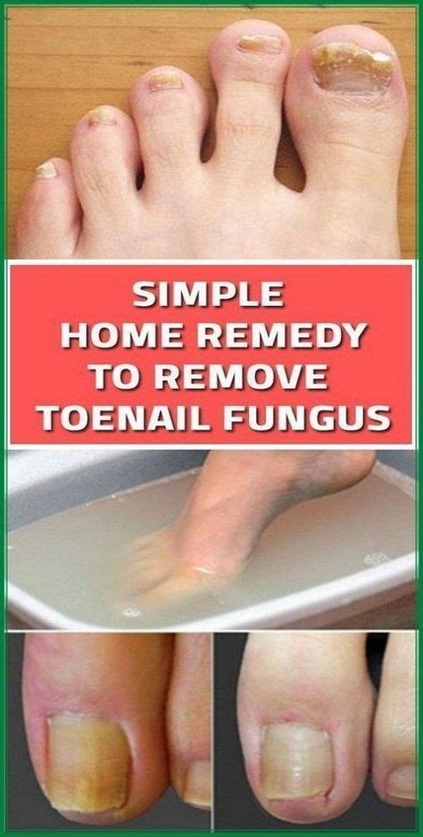 3 Simple And Effective Natural Cures For Toenail Fungus