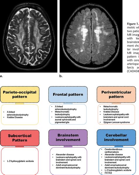 Figure 1 From Adult Leukodystrophies A Step By Step Diagnostic