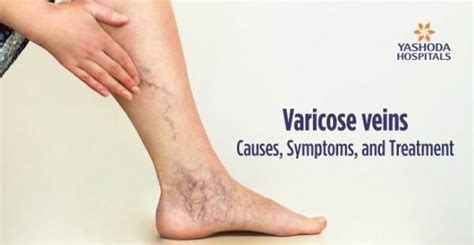 Varicose Veins Causes Symptoms Treatment Diagnosis And Prevention