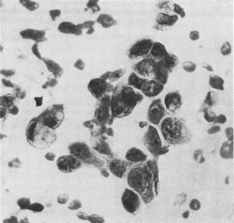 A Frozen Section Of A Lymph Node Infiltrated By Signet Ring Cell