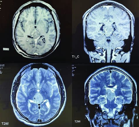 T Contrast And T Weighted Mri Showing Irregular Infiltrative Mass In