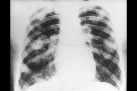 Rheumatology Image Bank Rheumatoid Arthritis Caplan S Syndrome