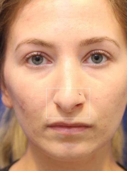 Patient 13541 Septoplasty Before And After Photos New York Ny