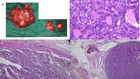 Macroscopically The Tumor From The Left Lobe Was Around 17 Cm In