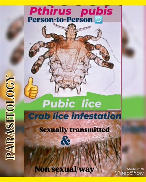 Eyelash Lice Crab Louse Pubic Lice Infestation Pthirus Pubis Stis And Non Sexual Way👍parasitology