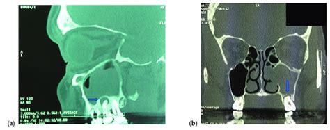 Computed Tomography Demonstrating Maxillary Sinusitis Secondary To A