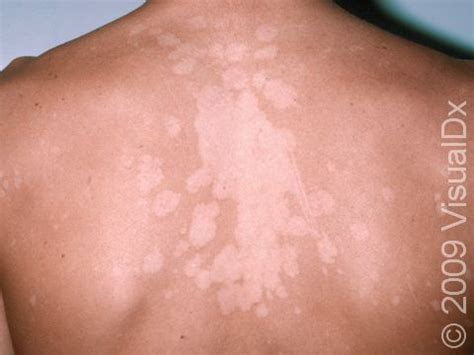 Tinea Versicolor Before And After