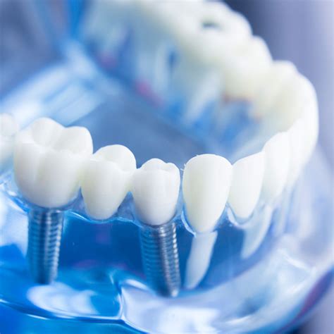 Premier Dental Implants Services In Beverly Hills Ca