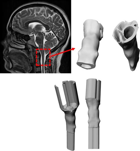 Association Between Resistance To Cerebrospinal Fluid Flow And Cardiac