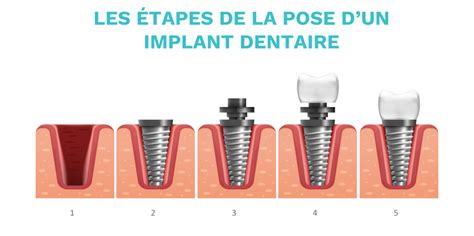 Pose Dun Implant Dentaire Tapes Cl S De La Proc Dure