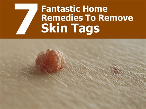 Fast Skin Tag Removal Information Dernasam