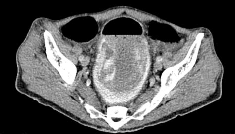 Case Report Rare Benign Colorectal Intussusception Due To Rectal Polyp