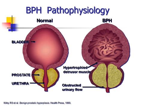 Benign Prostatic Hyperplasia Pathophysiology Diagram