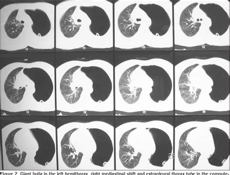 Pdf Giant Bulla Mimicking Tension Pneumothorax Semantic Scholar