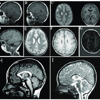 A B D Demonstrate Frontal And Frontotemporal Cobblestone Like Brain