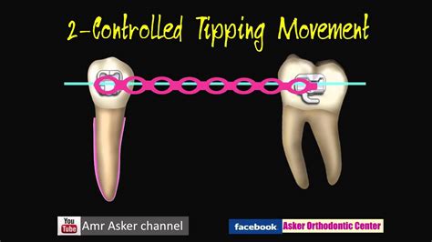 Types Of Orthodontic Tooth Movement Youtube