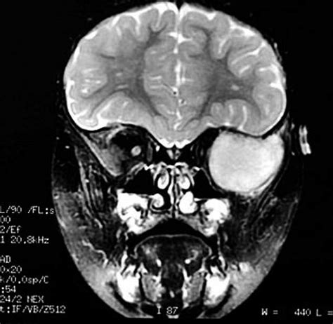 Mass centered in the greater wing of the left sphenoid bone with ...