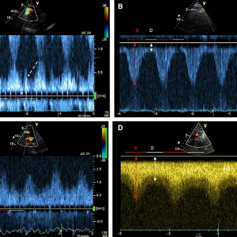 Pulsed Wave And Continuous Wave Doppler Echocardiographic Examination