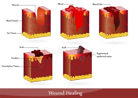 Wound healing stock vector. Image of anatomy, disease - 19023103