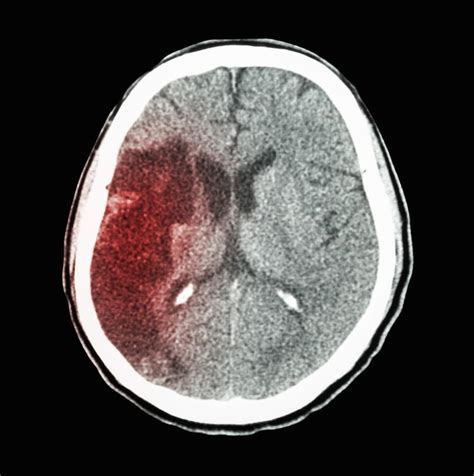 Intracranial Hemorrhage Pathophysiology