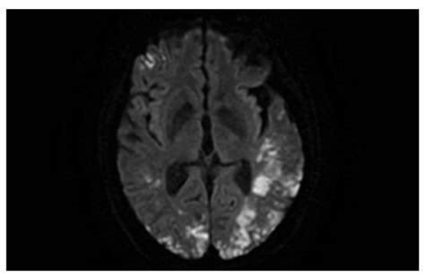 Intravascular Lymphoma of the Brain in 63-Year-Old Man | HSS Case