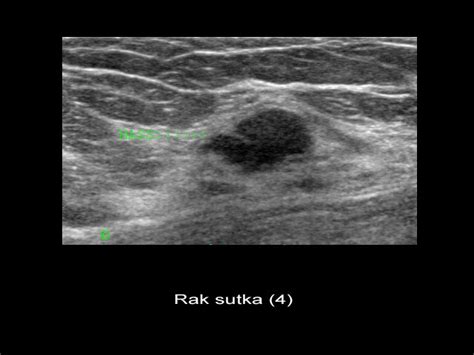 Usg Piersi Diagnoza Tkanki Gruczo Owej Sutka U Kobiet