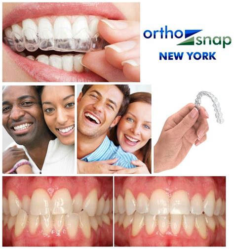 Orthosnap‬ Clear ‪‎aligners‬ Are Smooth And Comfortable Unlike Sharp Metal ‪‎braces‬ T