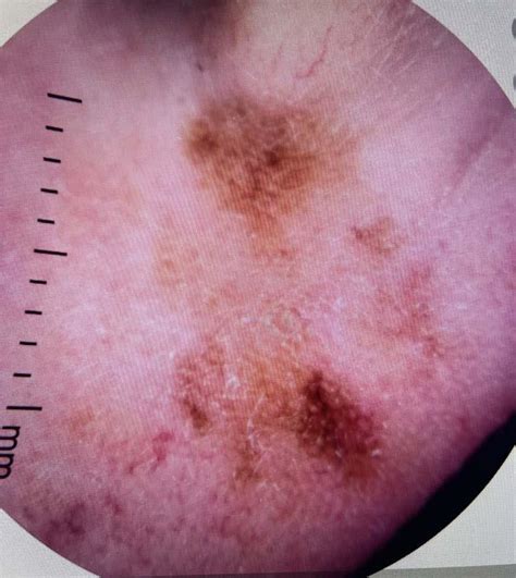 Serial Monitoring Of Melanoma On Earlobe Melanoma Scan