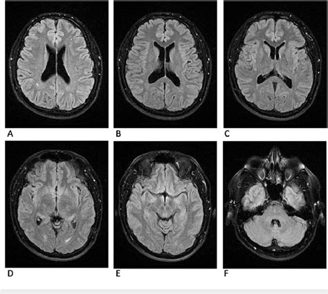 MRI brain T2 flair sequence 31 weeks after dual antiparasitic treatment... | Download Scientific ...