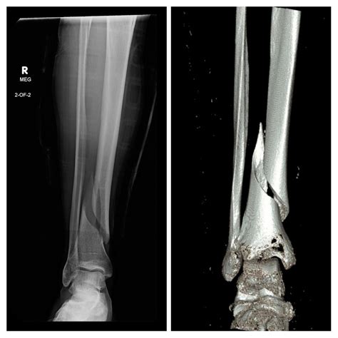 Pre op tib/fib fracture : r/XRayPorn