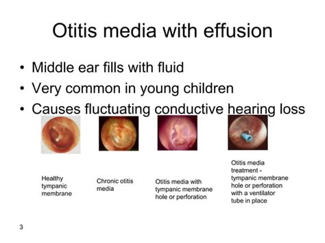 Otitis Media With Effusion An Illustration Of Ascertainment Bias