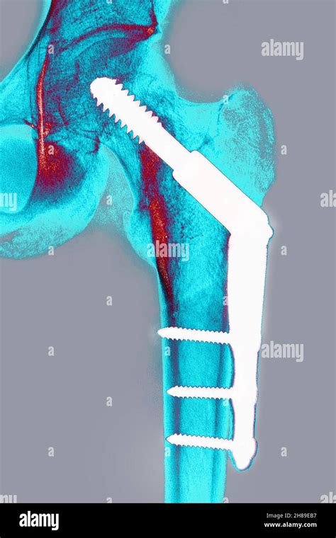 Osteosíntesis De Cadera Fotografía De Stock Alamy