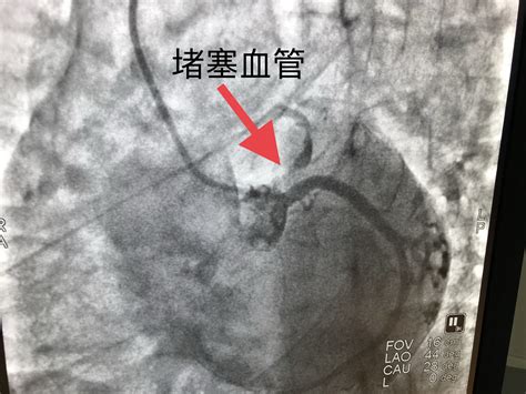 时间就是心肌，时间就是生命 ——怀化市第二人民医院靖州医院心血管内科急诊pci手术纪实 健康 怀化站 红网