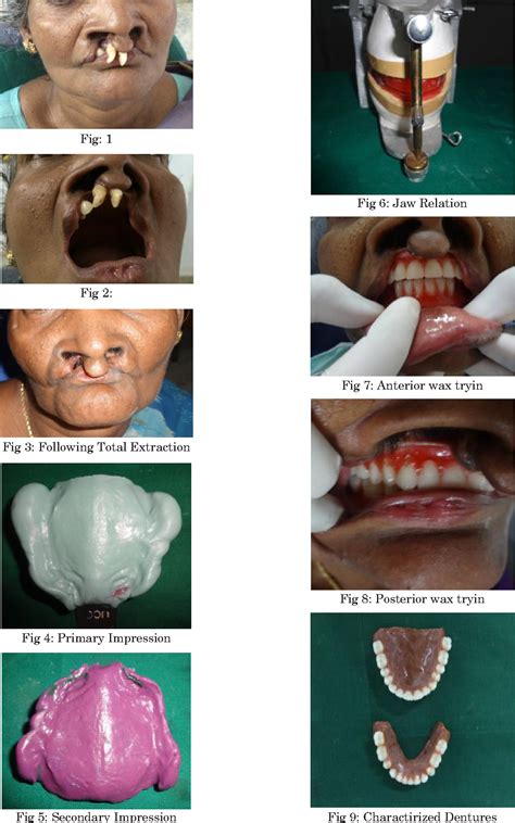 Cleft Lip And Palate Adults