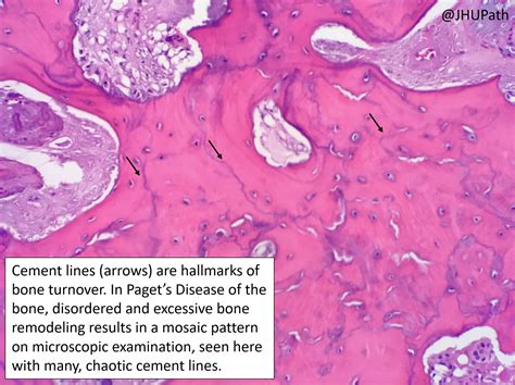 Pagets Disease Histology