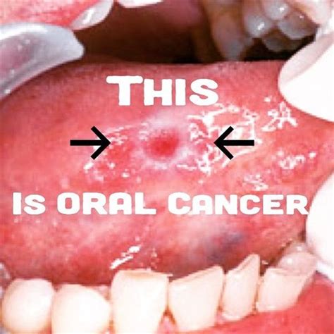 Oral Cancer On Tongue Look Like