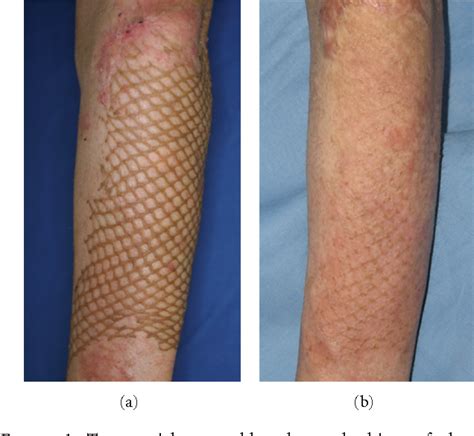 List 99 Pictures Burn Skin Graft Before And After Pictures Stunning