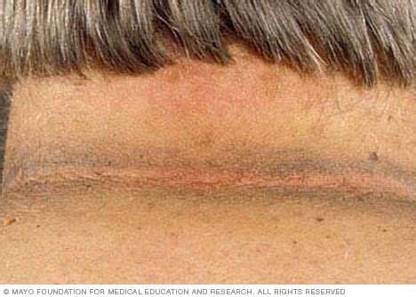 Acanthosis nigricans - Symptoms and causes - Mayo Clinic