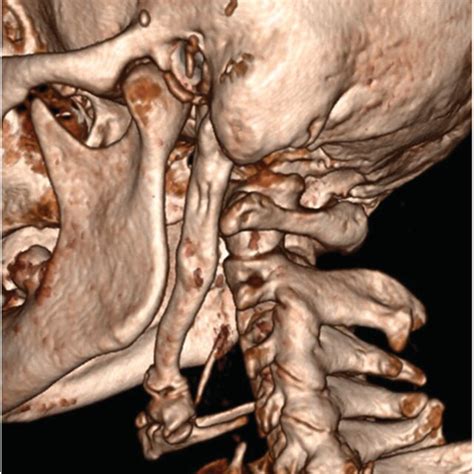 Elongated Left Styloid Process Completely Calcified Stylohyoid