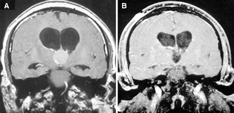 Figure 5 From Microsurgical Removal Of Intraventricular Lesions Using