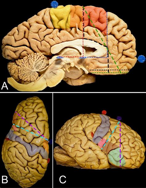 This figure presents the key aspects of frontal lobe surgery from the ...