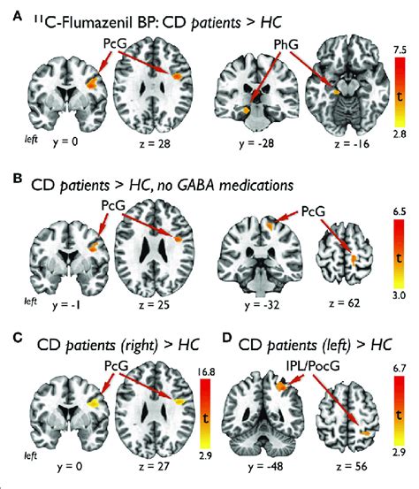 Results Of Voxel Based Analyses Showing A Significant Clusters In