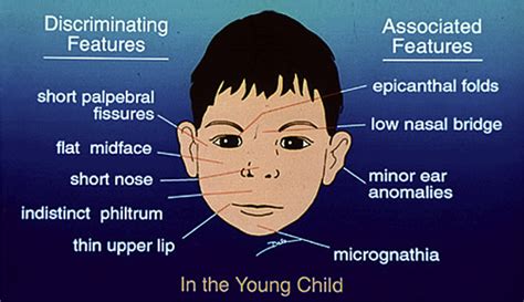 References In Fetal Alcohol Spectrum Disorders Paediatrics And Child